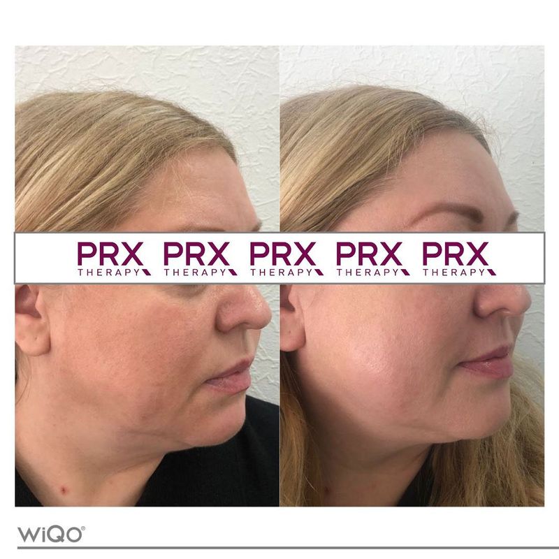 PRX behandeling before & after van vrouw