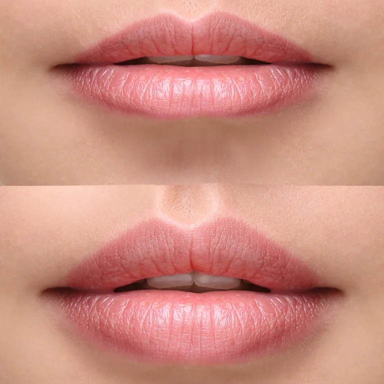 lip-filler-kalea-clinic